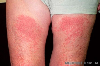 симптомы-аллергии-на-солнце